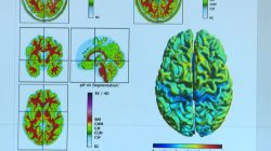 infeccao-leve-por-covid-tambem-pode-deixar-sequelas-como-fadiga,-sonolencia-e-ansiedade,-diz-estudo-da-unicamp